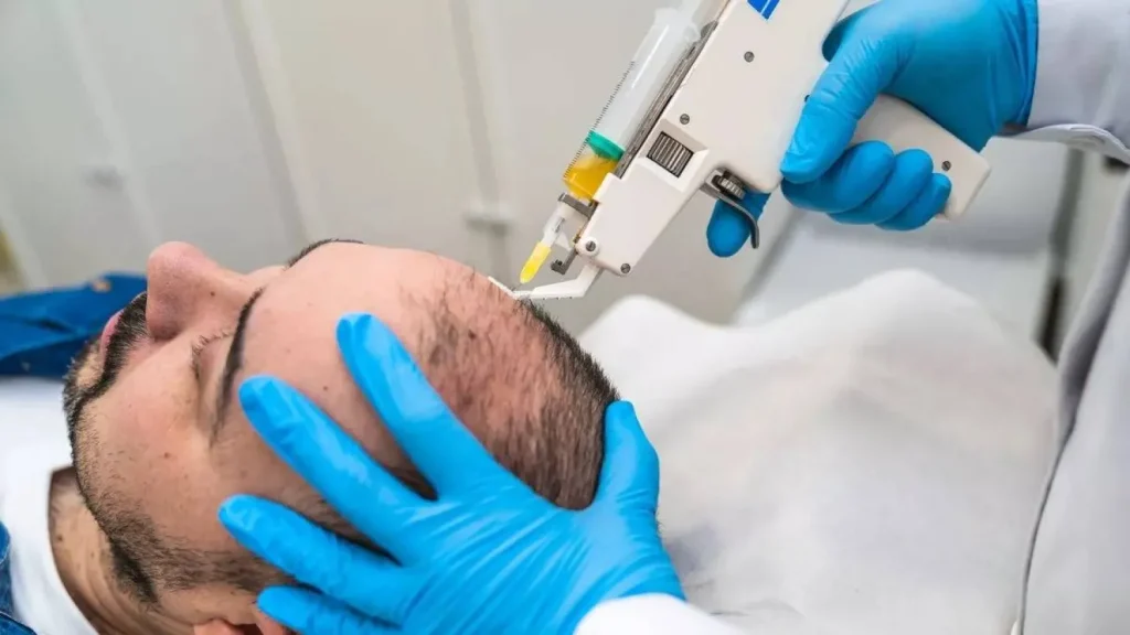 لأول مرة.. باحثون إسبان يطورون علاجا واعدا للصلع
